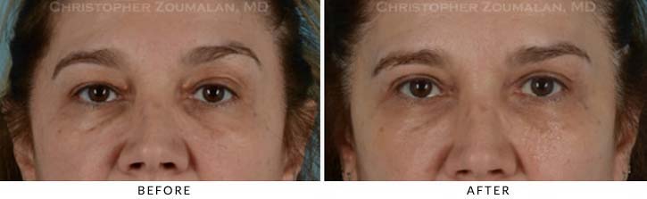 Benign Eyelid Lesions Before & After Photo - Patient Seeing Straight - Patient 2