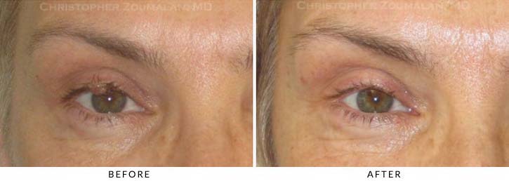 Benign Eyelid Lesions Before & After Photo - Patient Seeing Straight - Patient 3