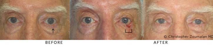 Left lower lid excision of basal cell carcinoma and reconstruction using a myocutaneous advancement flap - male patient before and after picture