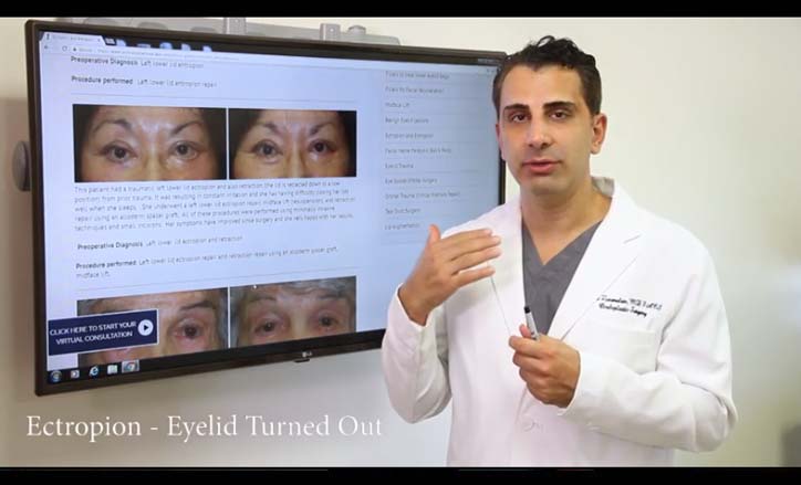 Eyelid malpositions - Click to view the Video