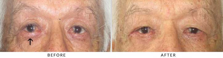 Ectropion and Entropion Before & After Photo -  - Patient 11