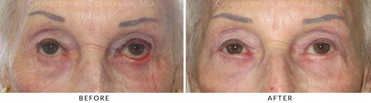 Ectropion and Entropion Before & After Photo -  - Patient 19