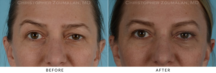 Endoscopic Brow Lift Before & After Photo - Patient Seeing Straight - Patient 13A