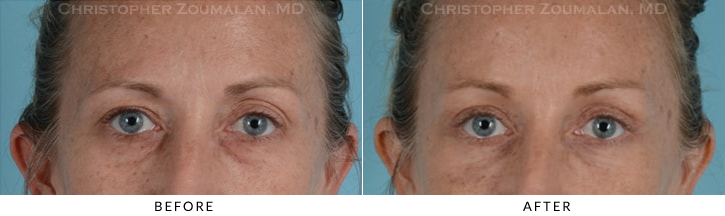 Endoscopic Brow Lift Before & After Photo - Patient Seeing Straight - Patient 14A