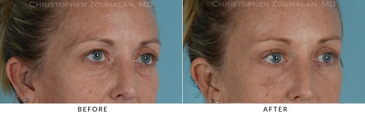 Endoscopic Brow Lift Before & After Photo - Patient Seeing Side - Patient 14D