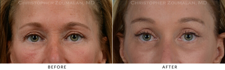 Endoscopic Brow Lift Before & After Photo - Patient Seeing Straight - Patient 16A