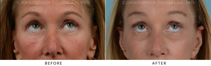 Endoscopic Brow Lift Before & After Photo - Patient Seeing Up - Patient 16B