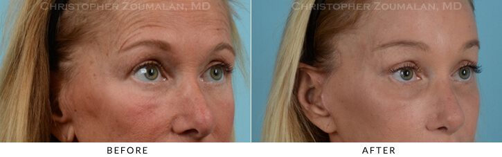 Endoscopic Brow Lift Before & After Photo - Patient Seeing Side - Patient 16C