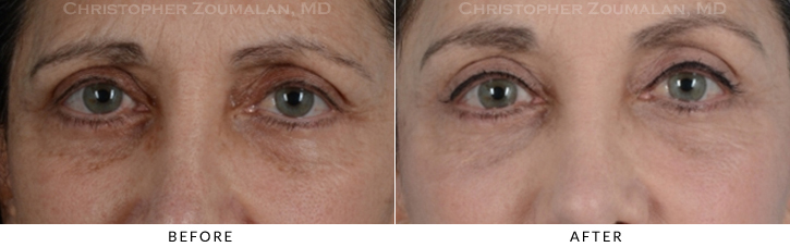 Endoscopic Brow Lift Before & After Photo - Patient Seeing Straight - Patient 17A