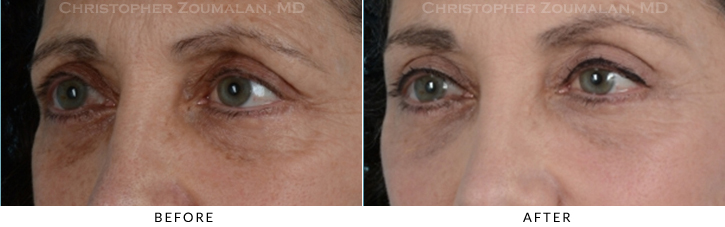 Endoscopic Brow Lift Before & After Photo - Patient Seeing Side - Patient 17B