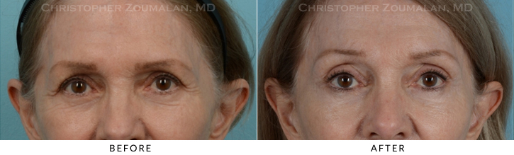 Endoscopic Brow Lift Before & After Photo - Patient Seeing Side - Patient 18A