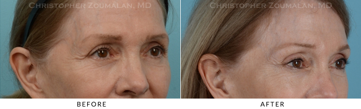 Endoscopic Brow Lift Before & After Photo - Patient Seeing Side - Patient 18C