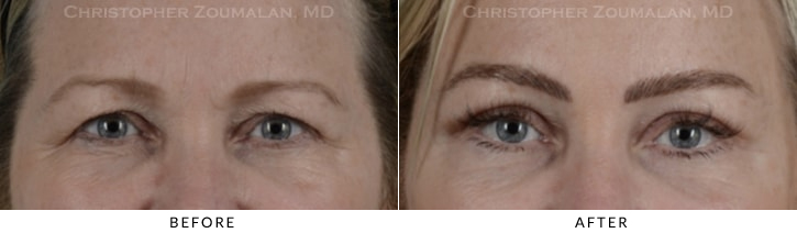 Endoscopic Brow Lift Before & After Photo - Patient Seeing Straight - Patient 19A