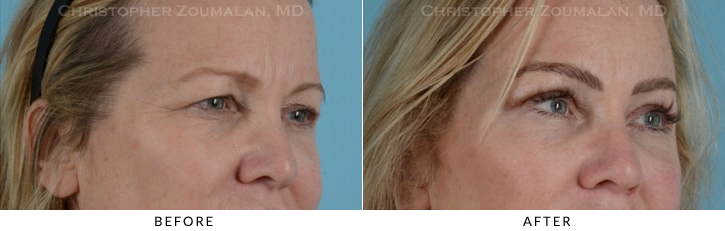 Endoscopic Brow Lift Before & After Photo - Patient Seeing Side - Patient 19E