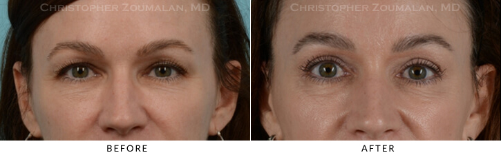 Endoscopic Brow Lift Before & After Photo -  - Patient 20