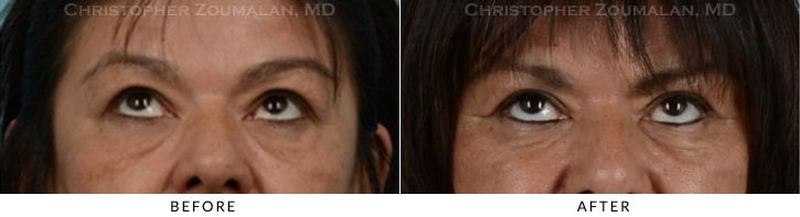 Endoscopic Brow Lift Before & After Photo - Patient Seeing Up - Patient 21B