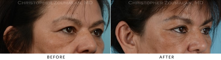 Endoscopic Brow Lift Before & After Photo - Patient Seeing Side - Patient 21C