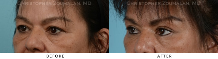 Endoscopic Brow Lift Before & After Photo - Patient Seeing Side - Patient 21D