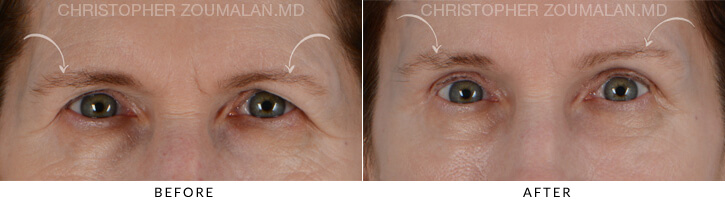 Endoscopic Brow Lift Before & After Photo - Patient Seeing Straight - Patient 3A