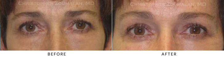 Endoscopic Brow Lift Before & After Photo - Patient Seeing Straight - Patient 31A