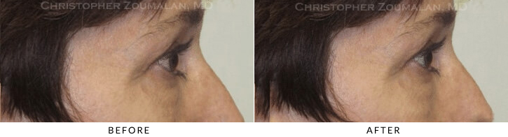 Endoscopic Brow Lift Before & After Photo - Patient Seeing Side - Patient 31B