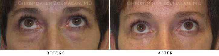 Endoscopic Brow Lift Before & After Photo - Patient Seeing Up - Patient 31C