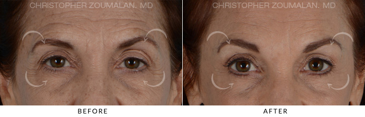 Endoscopic Brow Lift Before & After Photo - Patient Seeing Straight - Patient 4A