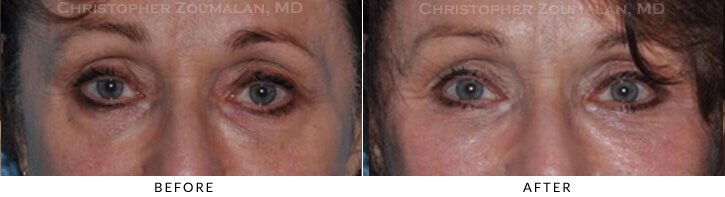 Endoscopic Brow Lift Before & After Photo -  - Patient 34