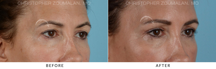 Endoscopic Brow Lift Before & After Photo - Patient Seeing Side - Patient 7A