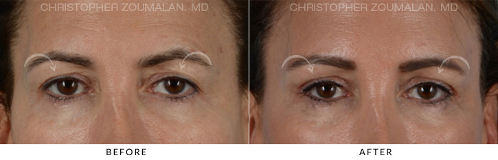 Endoscopic Brow Lift Before & After Photo - Patient Seeing Straight - Patient 7C