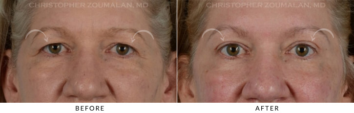 Endoscopic Brow Lift Before & After Photo - Patient Seeing Straight - Patient 9A