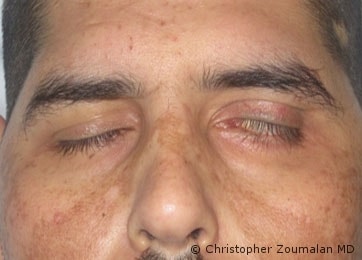 Upon closing his eyelids, he has an inability to properly close his left eyelids. As a result, he has exposure of his left eye - male patient before and after picture