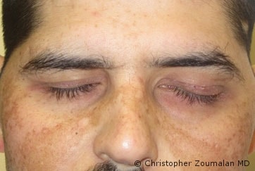 Placement of gold weight in the left upper eyelid and left lower lid canthoplasty - male patient before and after picture