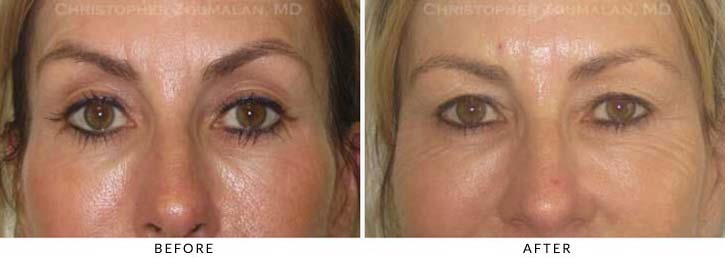 Fillers for Facial Rejuvenation Before & After Photo - Patient Seeing Straight - Patient 3