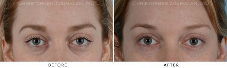 Fillers to treat lower eyelid hollowing Before & After Photo - Patient Seeing Straight - Patient 10A