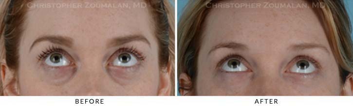 Fillers to treat lower eyelid hollowing Before & After Photo - Patient Seeing Up - Patient 10B