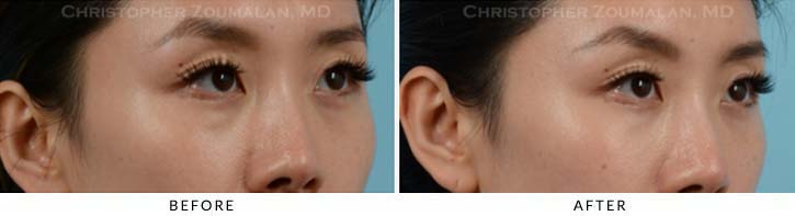 Fillers to treat lower eyelid hollowing Before & After Photo - Patient Seeing Side - Patient 11A