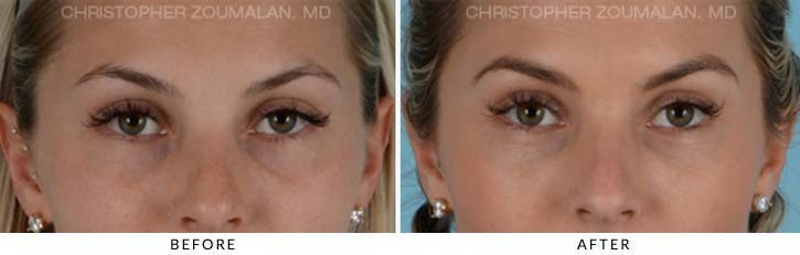 Fillers to treat lower eyelid hollowing Before & After Photo - Patient Seeing Straight - Patient 2A