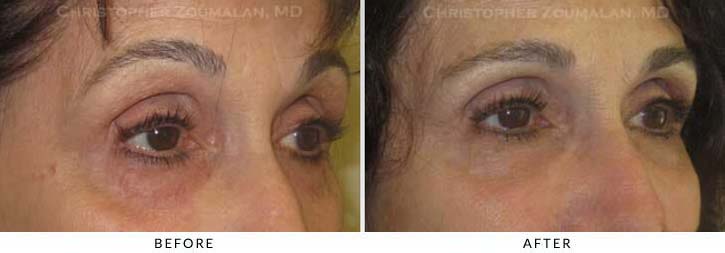 Fillers to treat lower eyelid hollowing Before & After Photo - Patient Seeing Side - Patient 37