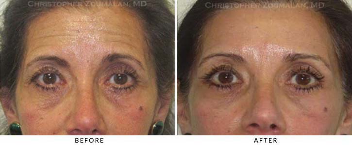 Fillers to treat lower eyelid hollowing Before & After Photo - Patient Seeing Straight - Patient 39