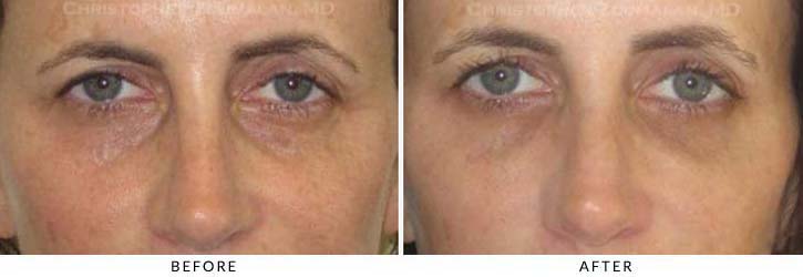 Fillers to treat lower eyelid hollowing Before & After Photo - Patient Seeing Straight - Patient 40