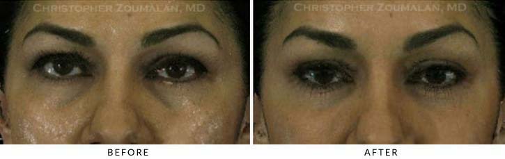 Fillers to treat lower eyelid hollowing Before & After Photo - Patient Seeing Straight - Patient 43