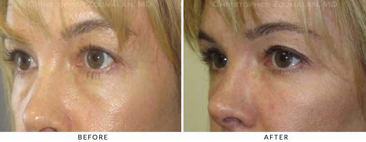 Fillers to treat lower eyelid hollowing Before & After Photo - Patient Seeing Side - Patient 46