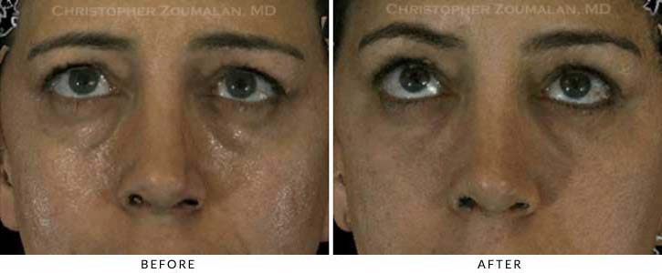 Fillers to treat lower eyelid hollowing Before & After Photo - Patient Seeing Up - Patient 48