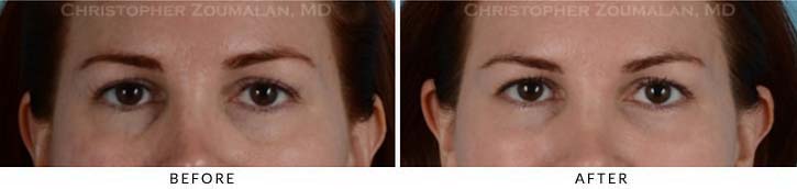 Fillers to treat lower eyelid hollowing Before & After Photo - Patient Seeing Straight - Patient 5A