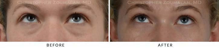 Fillers to treat lower eyelid hollowing Before & After Photo - Patient Seeing Up - Patient 7B