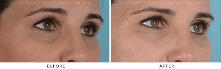 Fillers to treat lower eyelid hollowing Before & After Photo - Patient Seeing Side - Patient 8C