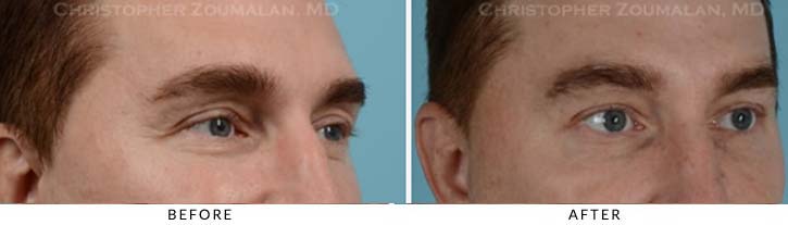 Fillers to Upper Lids Before & After Photo - Patient Seeing Side - Patient 2B