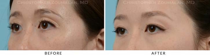 Fillers to Upper Lids Before & After Photo - Patient Seeing Side - Patient 3A