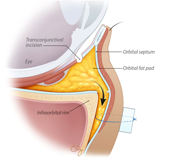 This is a side view picture illustration of how the fat pocket is repositioned to fill in the hollowing